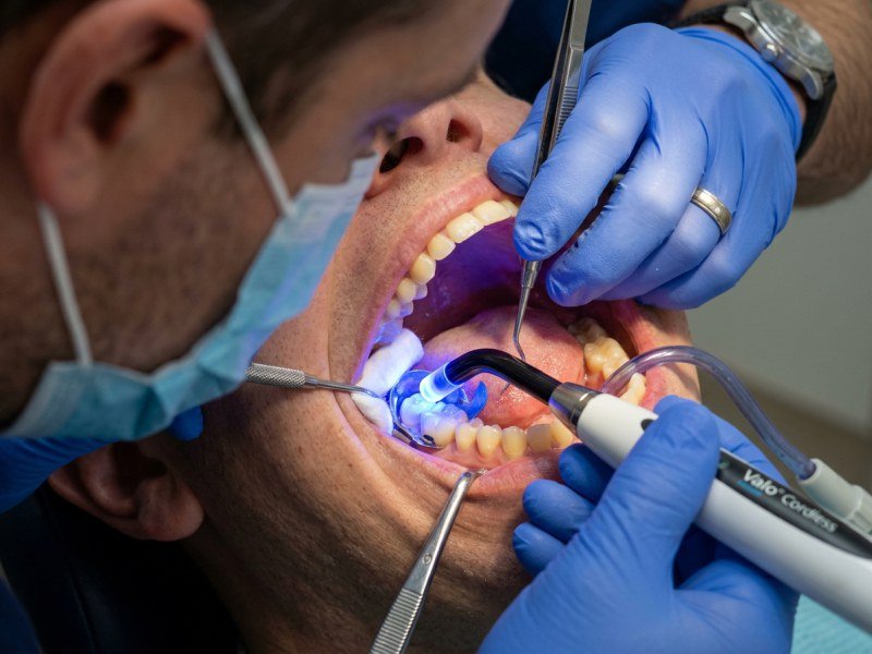 Tooth Coloured Composite Material Light Cured Cosmetic Filling