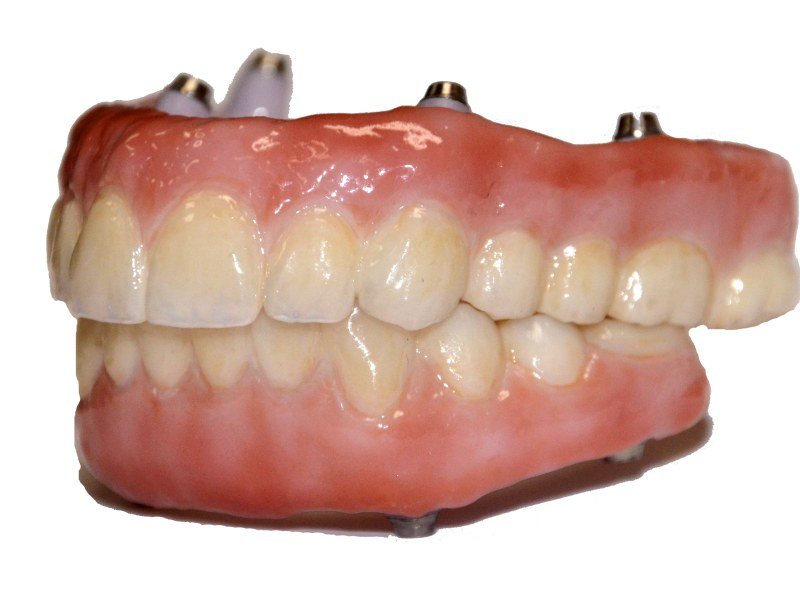 Construction Of Different Types Of Material's Dental Crowns & Bridges (White Metal/Ceramic Fused To Metal, Complete Ceramic Zirconia)