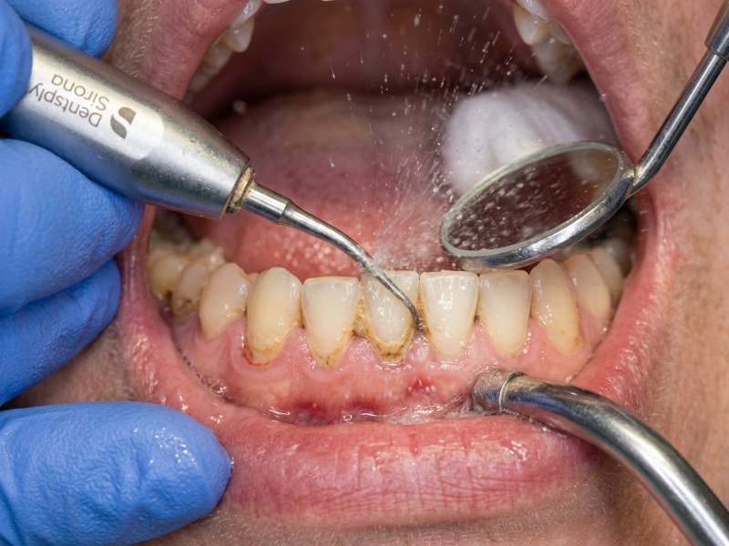 Teeth Cleaning (Scaling & Polishing)