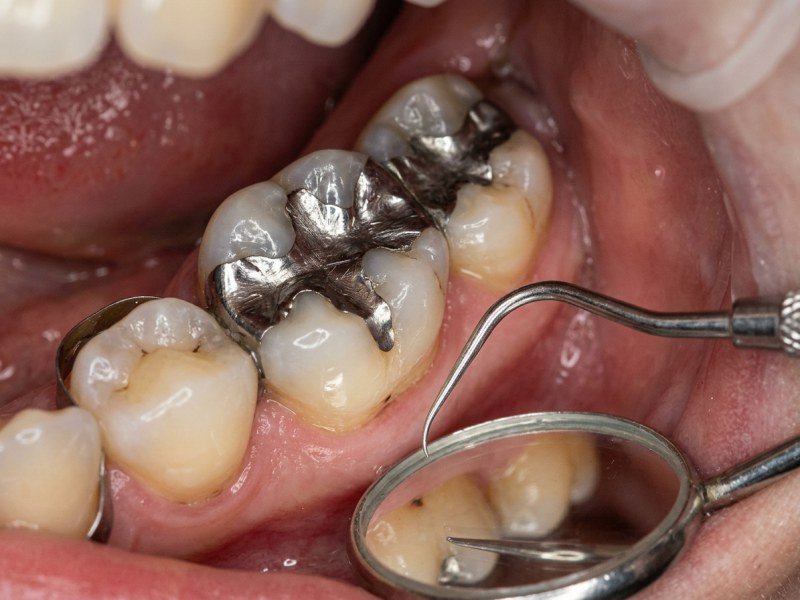 Silver Amalgam Dental Filling