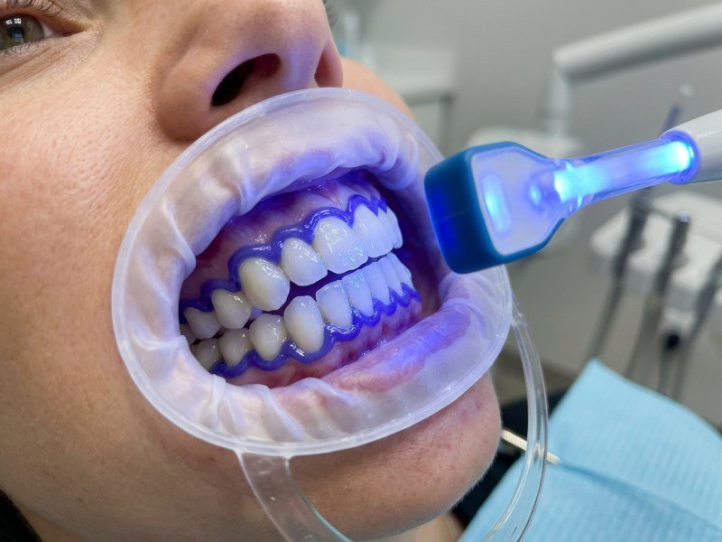 Teeth Bleaching (Teeth Whitening)